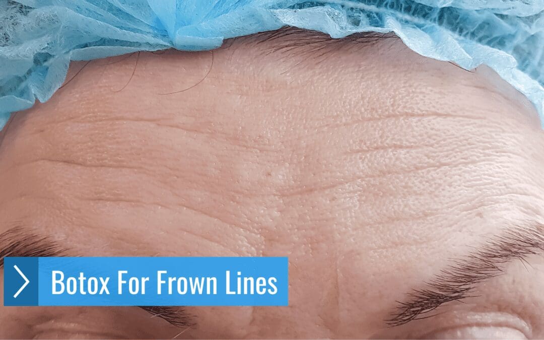 How Botox For Frown Lines Changes Your Mood